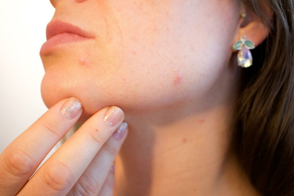 junges Mädchen Akne Hautprobleme Diese Hautpflege-Fehler können Akne verursachen