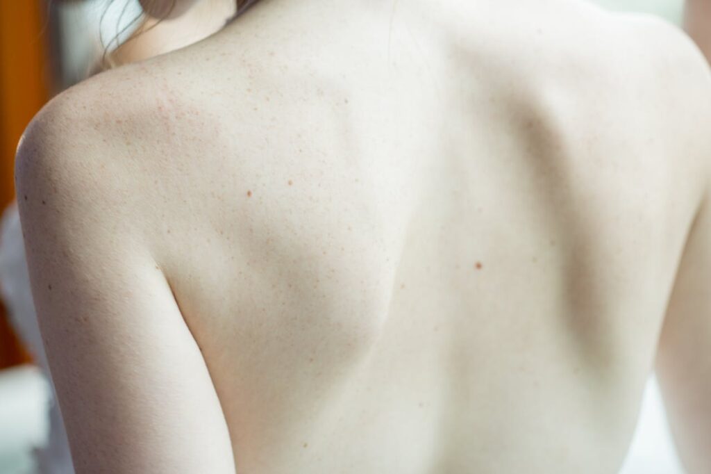 Haut Rücken Haarentfernung mit dem Laser Wissenswerte Fakten